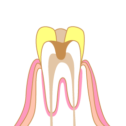 虫歯の図
