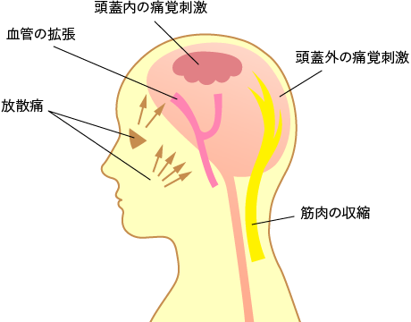頭痛のメカニズム イメージ図