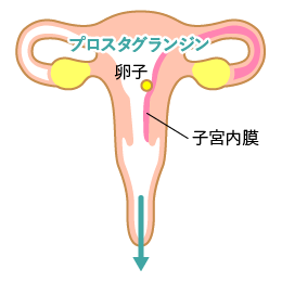 プロスタグランジンの過剰分泌の図