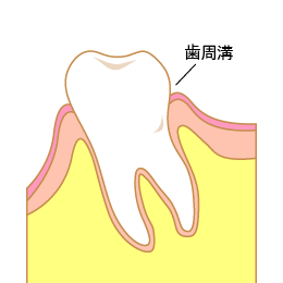 歯周病の図