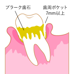 歯周病の図