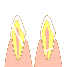 歯の破折の図